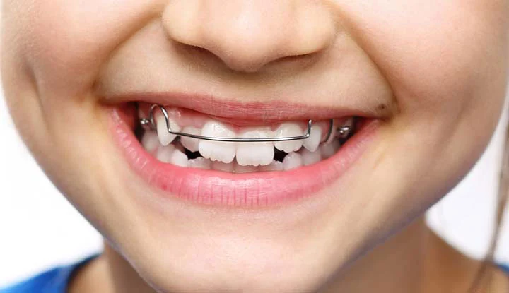 Macrodontia: Big Teeth Syndrome: Can it Be Treated?