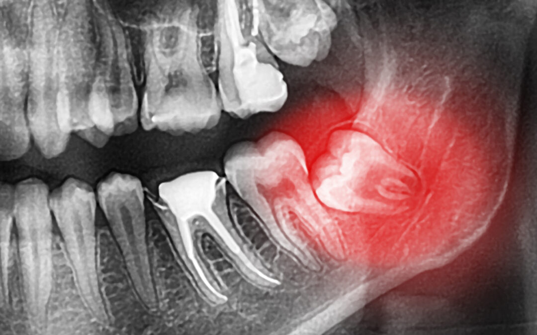 Wisdom Teeth Removal: How It Can Benefit Your Long-Term Health