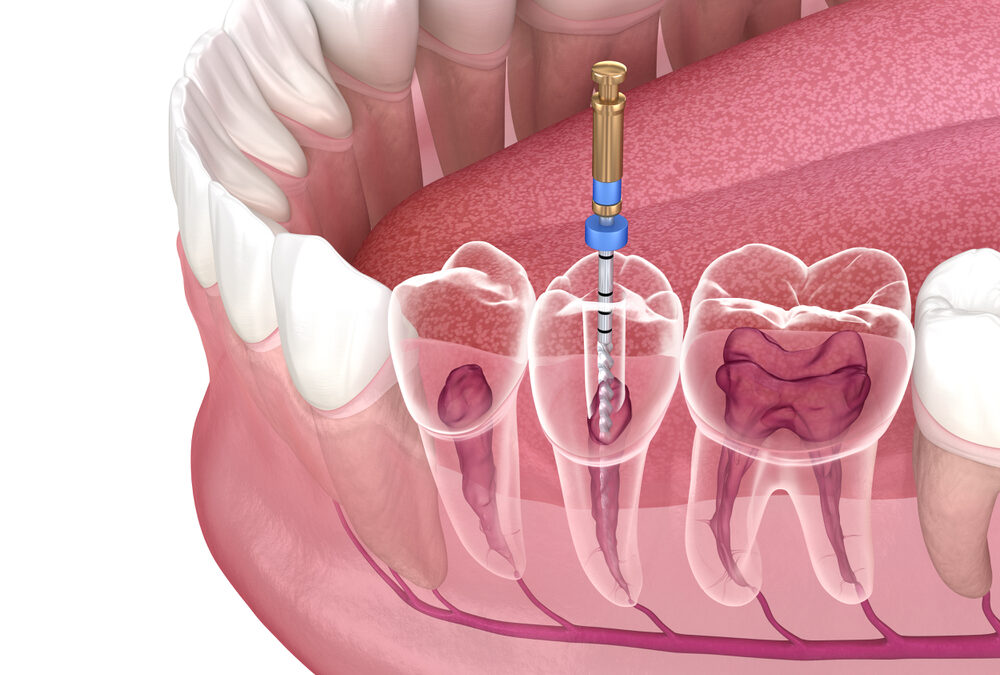 Root Canals Explained: What Happens to Your Tooth Nerve and Why It Matters