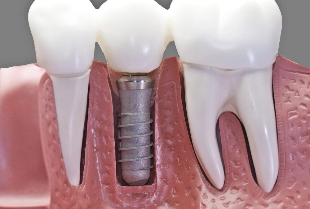 Navigating the Pros and Cons of Modern Dental Implant Technology