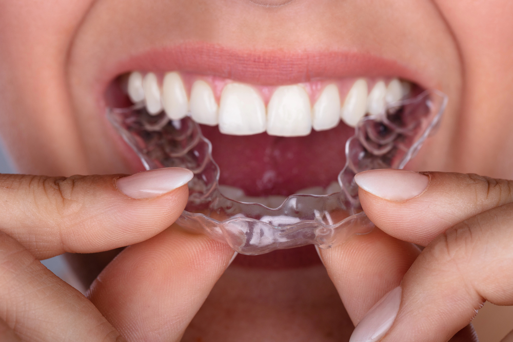 Invisalign