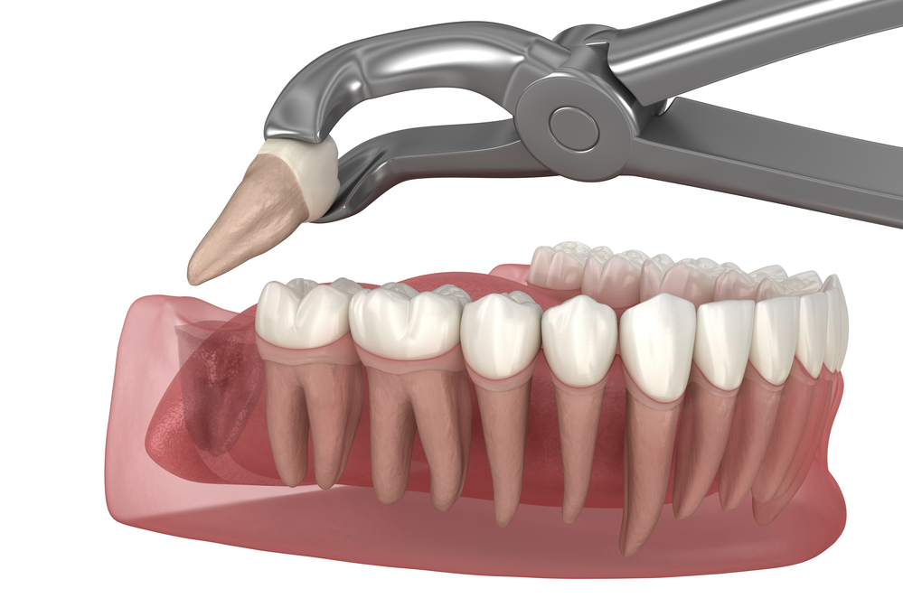How to Prepare for Your Wisdom Tooth Surgery
