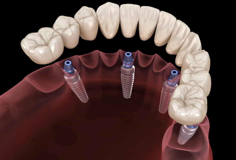 Why All-On-4 Plus™ is Changing the Game in Implant Dentistry