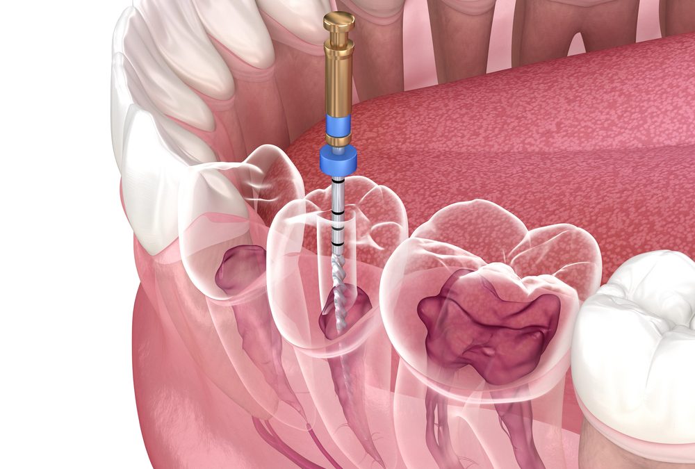 Advanced Root Canal Treatment: How Modern Technology Is Changing the Patient Experience